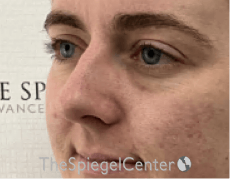 Tear Trough / Under Eye Fillers Before & After Gallery - Patient 200416 - Image 3