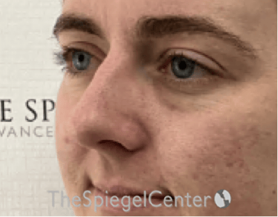 Tear Trough / Under Eye Fillers Before & After Gallery - Patient 200416 - Image 3