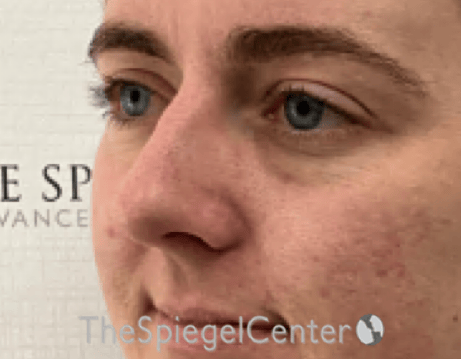 Tear Trough / Under Eye Fillers Before & After Gallery - Patient 200416 - Image 3