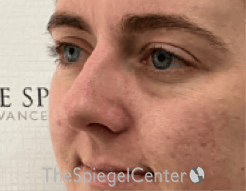 Tear Trough / Under Eye Fillers Before & After Gallery - Patient 200416 - Image 3