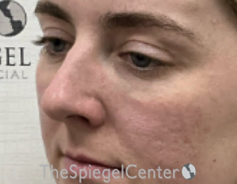 Tear Trough / Under Eye Fillers Before & After Gallery - Patient 200416 - Image 4