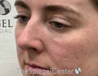 Tear Trough / Under Eye Fillers Before & After Gallery - Patient 200416 - Image 4