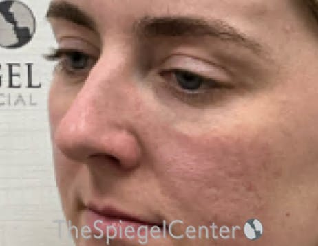 Tear Trough / Under Eye Fillers Before & After Gallery - Patient 200416 - Image 4