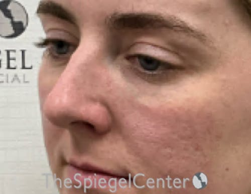Tear Trough / Under Eye Fillers Before & After Gallery - Patient 200416 - Image 4