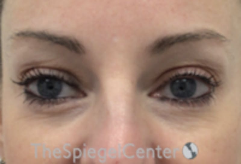 Tear Trough / Under Eye Fillers Before & After Gallery - Patient 485245 - Image 1