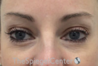Tear Trough / Under Eye Fillers Before & After Gallery - Patient 485245 - Image 1