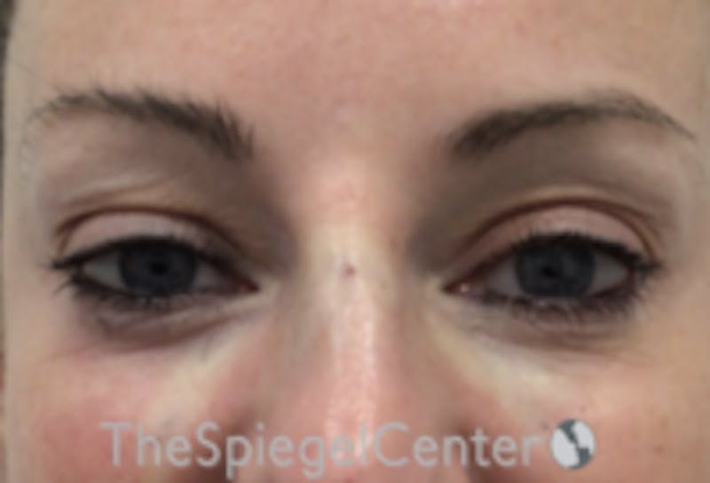 Tear Trough / Under Eye Fillers Before & After Gallery - Patient 485245 - Image 2