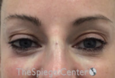 Tear Trough / Under Eye Fillers Before & After Gallery - Patient 485245 - Image 2
