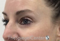 Tear Trough / Under Eye Fillers Before & After Gallery - Patient 485245 - Image 3
