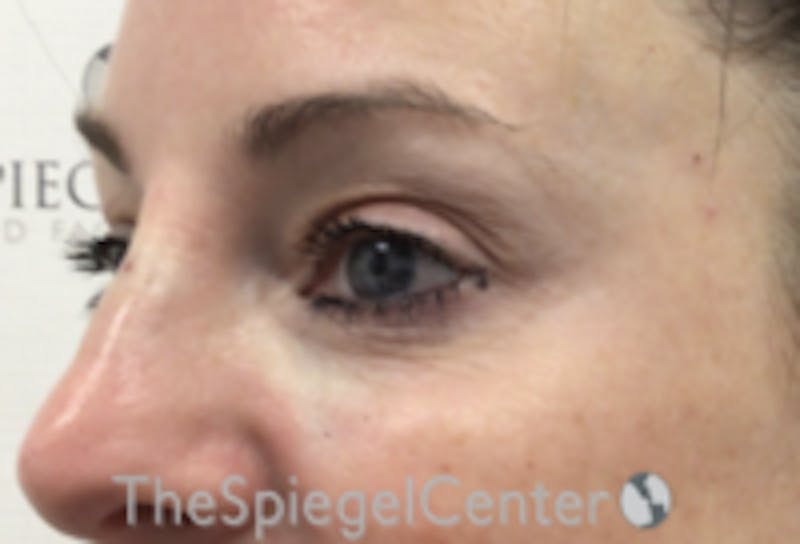 Tear Trough / Under Eye Fillers Before & After Gallery - Patient 485245 - Image 4