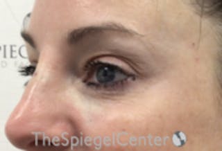 Tear Trough / Under Eye Fillers Before & After Gallery - Patient 485245 - Image 4