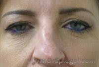 Tear Trough / Under Eye Fillers Before & After Gallery - Patient 329226 - Image 1
