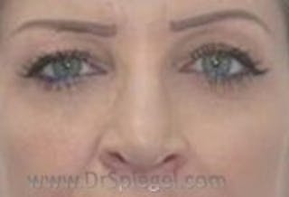 Tear Trough / Under Eye Fillers Before & After Gallery - Patient 329226 - Image 2