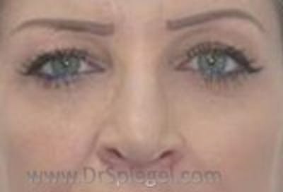 Tear Trough / Under Eye Fillers Before & After Gallery - Patient 329226 - Image 2