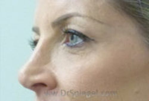 Tear Trough / Under Eye Fillers Before & After Gallery - Patient 329226 - Image 4