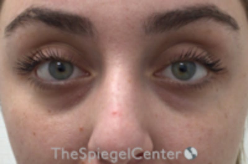 Tear Trough / Under Eye Fillers Before & After Gallery - Patient 742037 - Image 1