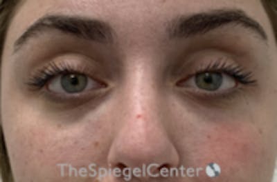 Tear Trough / Under Eye Fillers Before & After Gallery - Patient 742037 - Image 2