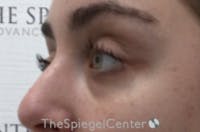 Tear Trough / Under Eye Fillers Before & After Gallery - Patient 742037 - Image 3