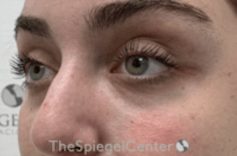 Tear Trough / Under Eye Fillers Before & After Gallery - Patient 742037 - Image 4