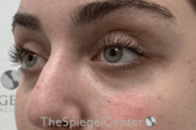 Tear Trough / Under Eye Fillers Before & After Gallery - Patient 742037 - Image 4