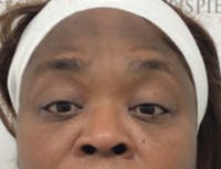 Tear Trough / Under Eye Fillers Before & After Gallery - Patient 148200 - Image 1
