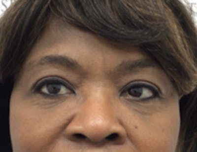 Tear Trough / Under Eye Fillers Before & After Gallery - Patient 148200 - Image 2