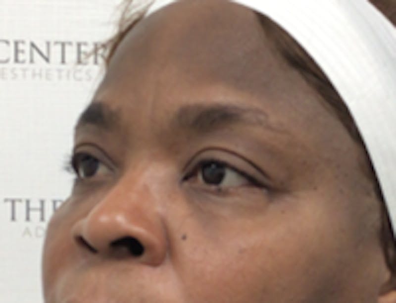 Tear Trough / Under Eye Fillers Before & After Gallery - Patient 148200 - Image 3