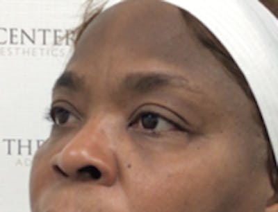 Tear Trough / Under Eye Fillers Before & After Gallery - Patient 148200 - Image 3