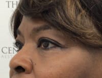 Tear Trough / Under Eye Fillers Before & After Gallery - Patient 148200 - Image 4