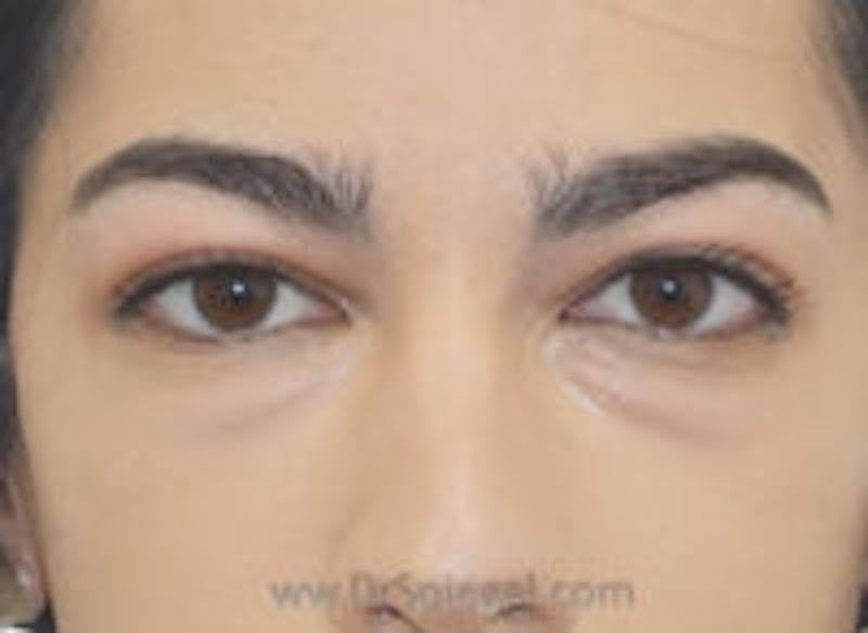 Tear Trough / Under Eye Fillers Before & After Gallery - Patient 128914 - Image 1