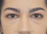 Tear Trough / Under Eye Fillers Before & After Gallery - Patient 128914 - Image 1