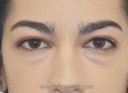Tear Trough / Under Eye Fillers Before & After Gallery - Patient 128914 - Image 1