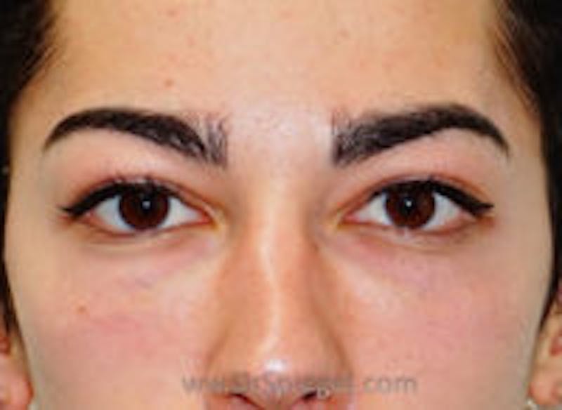 Tear Trough / Under Eye Fillers Before & After Gallery - Patient 128914 - Image 2
