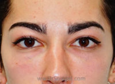 Tear Trough / Under Eye Fillers Before & After Gallery - Patient 128914 - Image 2