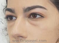Tear Trough / Under Eye Fillers Before & After Gallery - Patient 128914 - Image 3