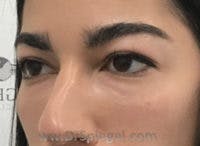 Tear Trough / Under Eye Fillers Before & After Gallery - Patient 128914 - Image 4