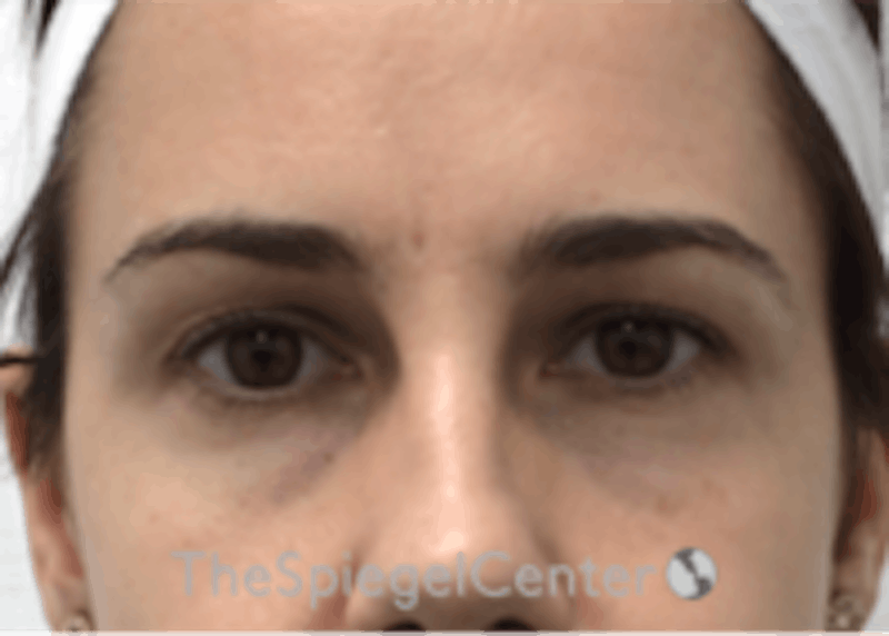 Tear Trough / Under Eye Fillers Before & After Gallery - Patient 590522 - Image 1