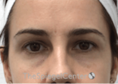 Tear Trough / Under Eye Fillers Before & After Gallery - Patient 590522 - Image 1