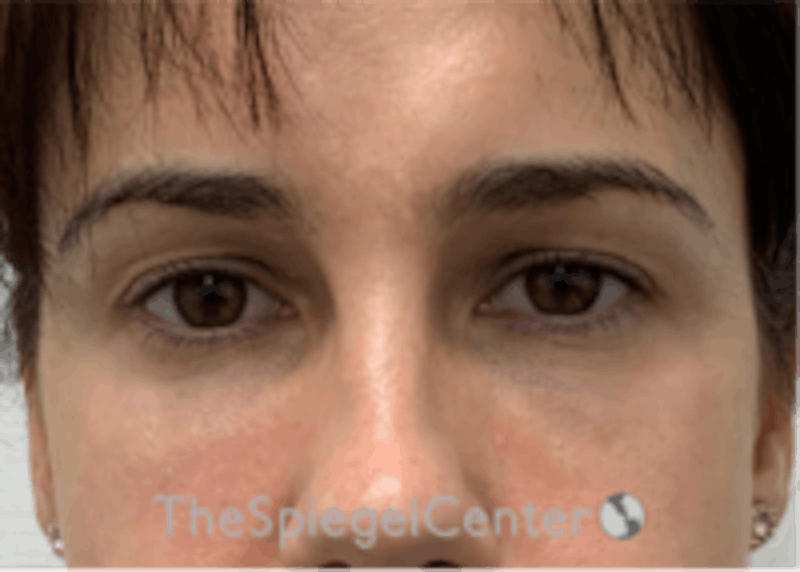 Tear Trough / Under Eye Fillers Before & After Gallery - Patient 590522 - Image 2
