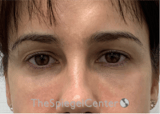 Tear Trough / Under Eye Fillers Before & After Gallery - Patient 590522 - Image 2