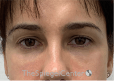 Tear Trough / Under Eye Fillers Before & After Gallery - Patient 590522 - Image 2