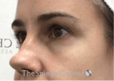 Tear Trough / Under Eye Fillers Before & After Gallery - Patient 590522 - Image 3
