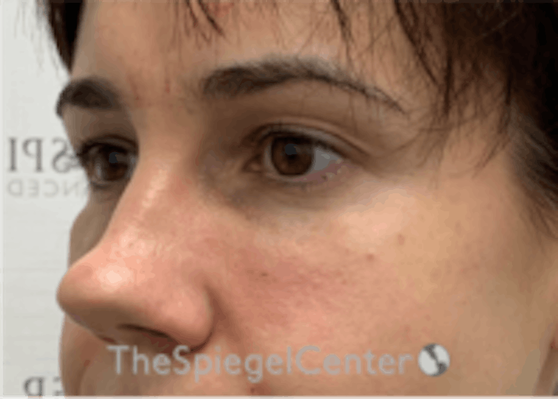 Tear Trough / Under Eye Fillers Before & After Gallery - Patient 590522 - Image 4