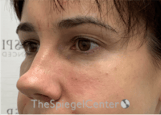Tear Trough / Under Eye Fillers Before & After Gallery - Patient 590522 - Image 4