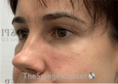 Tear Trough / Under Eye Fillers Before & After Gallery - Patient 590522 - Image 4
