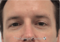 Tear Trough / Under Eye Fillers Before & After Gallery - Patient 273099 - Image 1