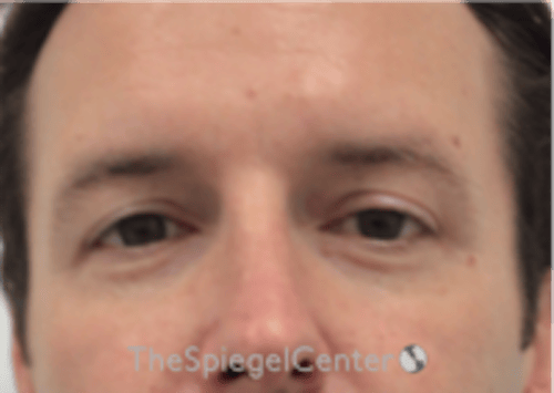 Tear Trough / Under Eye Fillers Before & After Gallery - Patient 273099 - Image 1