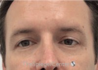 Tear Trough / Under Eye Fillers Before & After Gallery - Patient 273099 - Image 2
