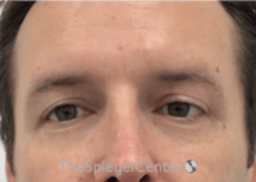 Tear Trough / Under Eye Fillers Before & After Gallery - Patient 273099 - Image 2