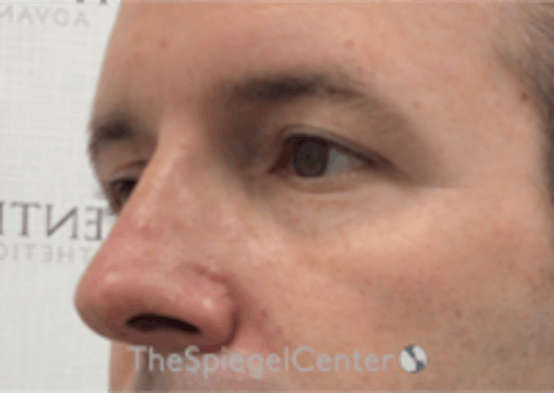 Tear Trough / Under Eye Fillers Before & After Gallery - Patient 273099 - Image 3
